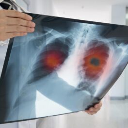 Doctor care ține în mână radiografie de plămâni. Un studiu a descoperit de ce unii oameni care fumează toată viața nu fac cancer pulmonar