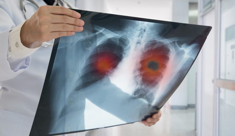 Doctor care ține în mână radiografie de plămâni. Un studiu a descoperit de ce unii oameni care fumează toată viața nu fac cancer pulmonar
