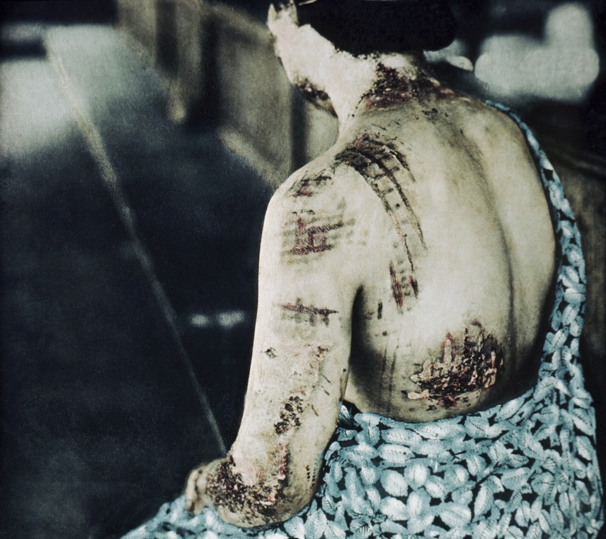 Victimă a bombardamentului de la Hiroshima, cu urme pe spate