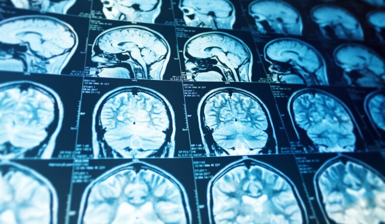 Radiografie a creierului, ce are o nouă funcție