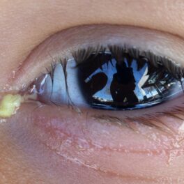 Copil care are substanța gălbuie din colțul ochilor, ce e compusă din praf și bacterii