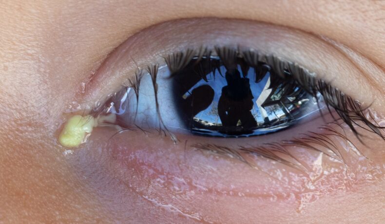 Copil care are substanța gălbuie din colțul ochilor, ce e compusă din praf și bacterii
