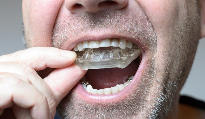 Bărbat care își pune o gutieră invizibilă pe dinți, similară cu dispozitivul care îți transformă limba într-un mouse